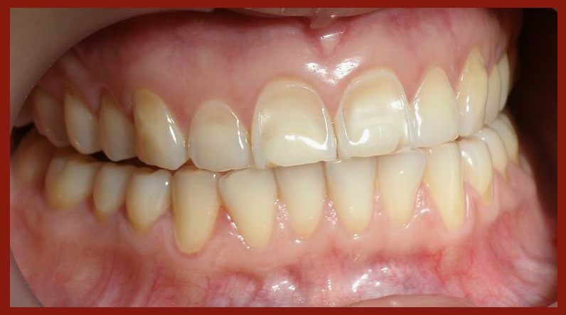 Какое существует лечение мраморной болезни зубов