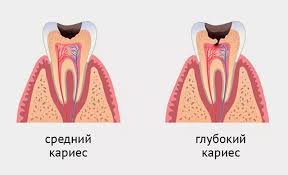 Лечение среднего кариеса в клинике 