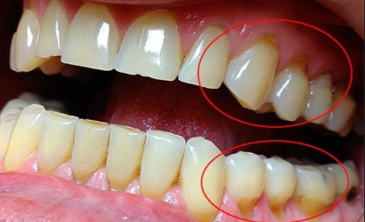 Що варто знати про пародонтит. Як лікувати це захворювання і чому зволікання може бути небезпечним