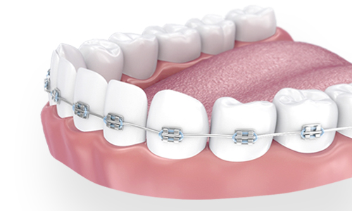 Як проводиться лікування зубів перед брекетами у My Smile