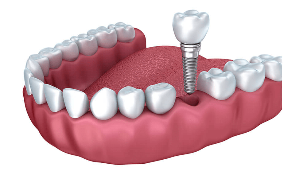 Импланты в стоматологии