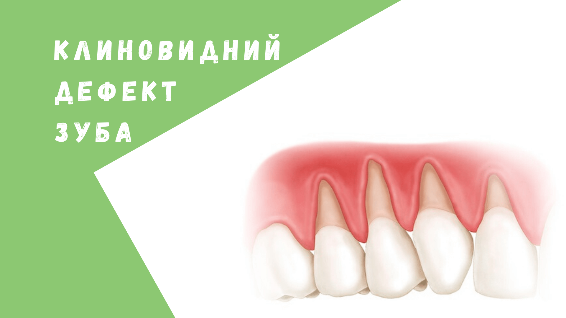 лікування клиноподібного дефекту