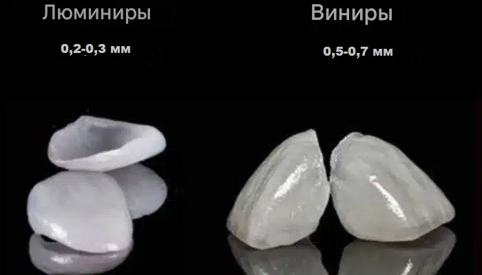 Какие отличия имеют люминиры и виниры