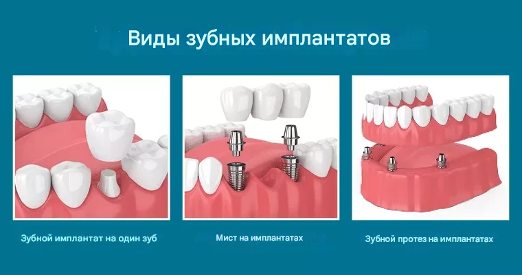 Несъемные конструкции