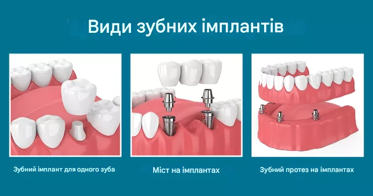 Незнімні конструкції