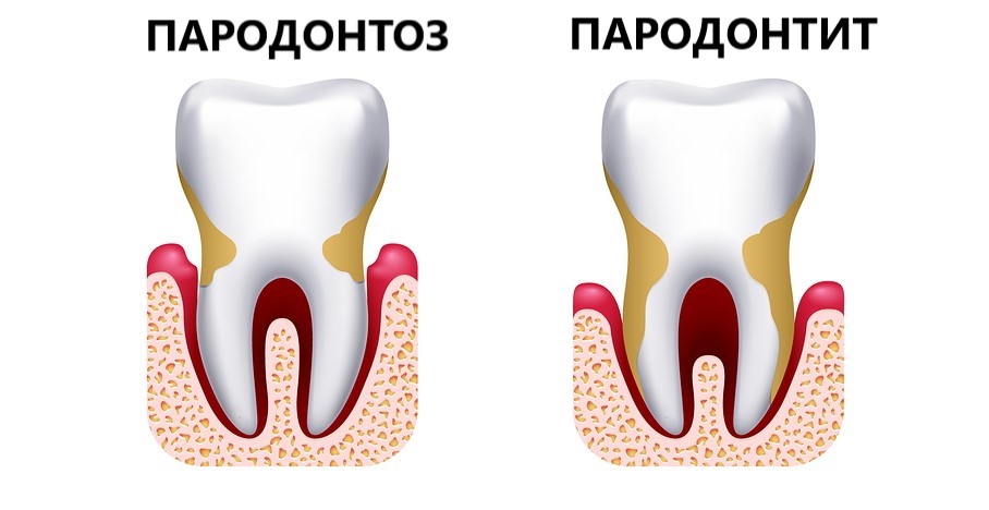 Що варто знати про пародонтоз, і чим він відрізняється від пародонтиту