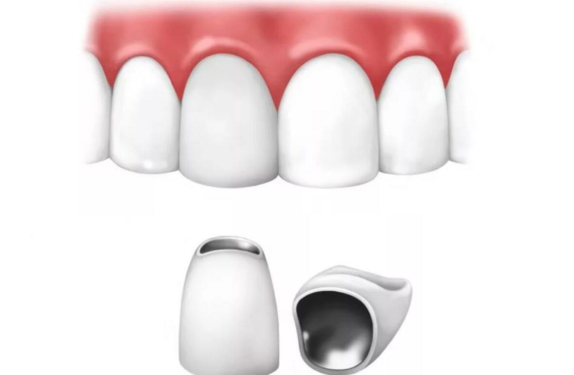 Як ставлять коронки на передні зуби