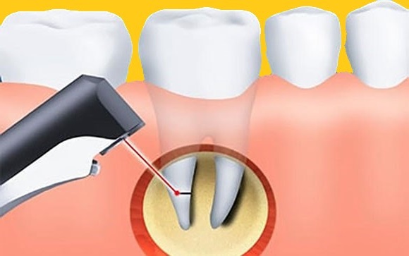 Что такое резекция корня зуба и как она работает