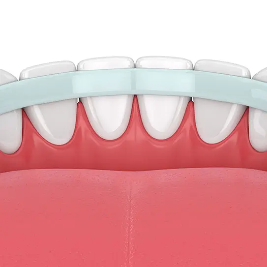 Що таке шинування зубів і в яких випадках воно необхідне