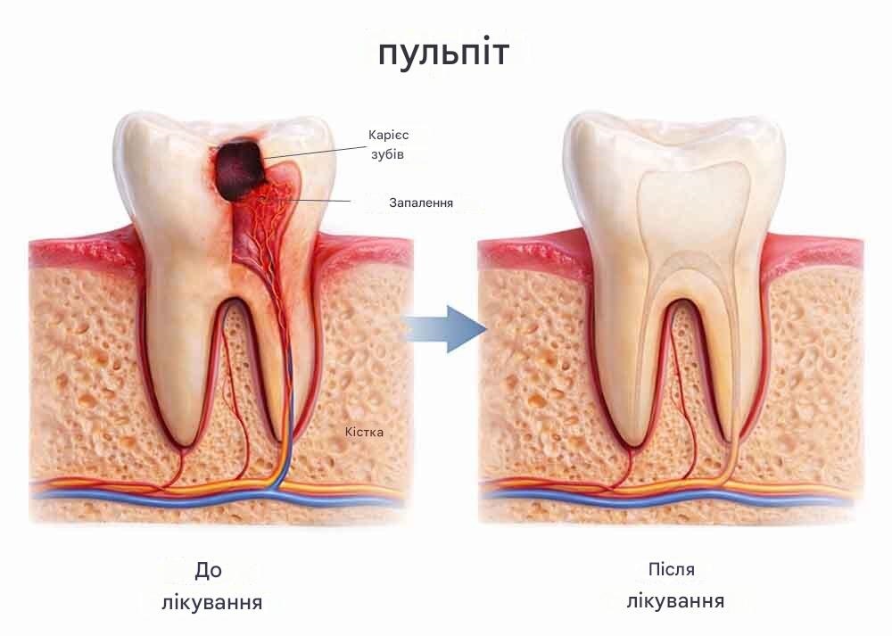 Що таке гангрена пульпи, лікування та сучасні підходи в терапії